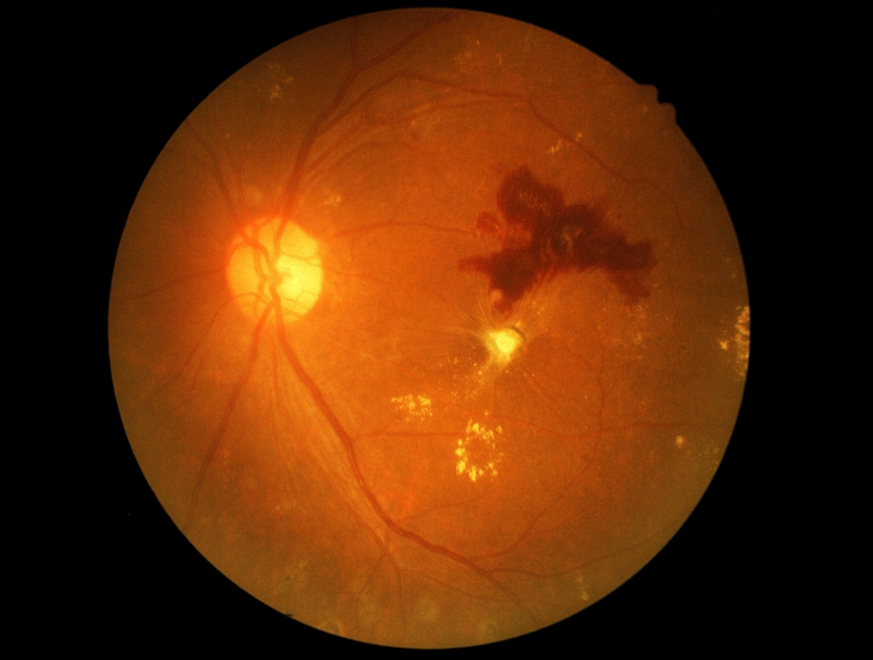 diabetic retinopathy article